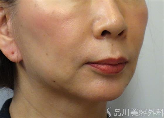 症例NO.38313のBEFORE写真