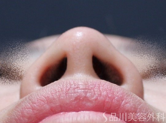 症例NO.67878のAFTER写真