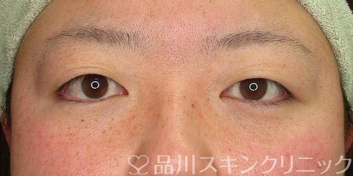 症例NO.69877のAFTER写真