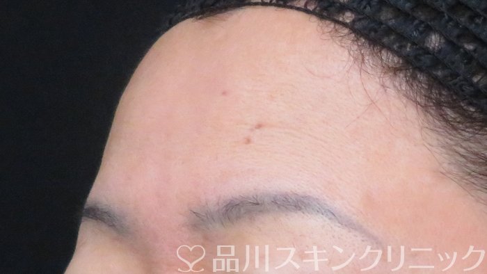 症例NO.71367のBEFORE写真