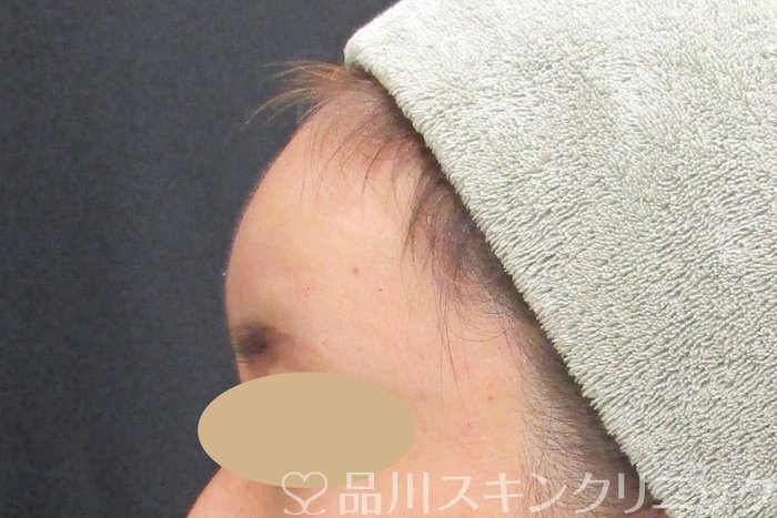 症例NO.74720のAFTER写真