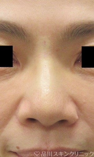 症例NO.69373のAFTER写真