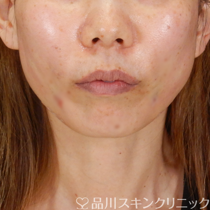 症例NO.63104のAFTER写真