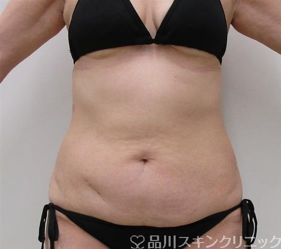 症例NO.35871のBEFORE写真