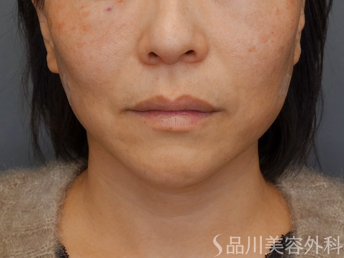 症例NO.72650のAFTER写真