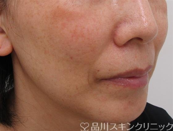 症例NO.37888のBEFORE写真