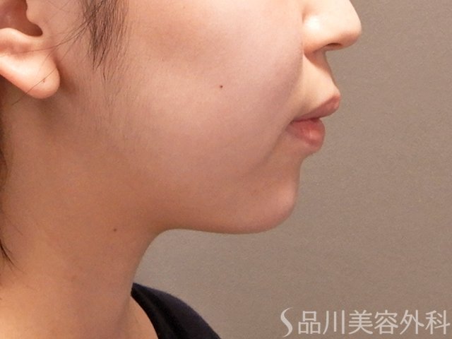 症例NO.70992のAFTER写真