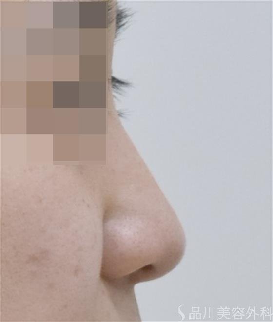 症例NO.50692のBEFORE写真