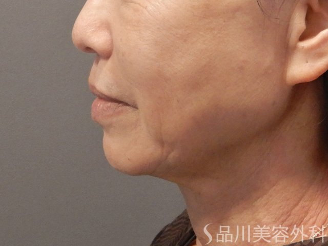 症例NO.72327のBEFORE写真