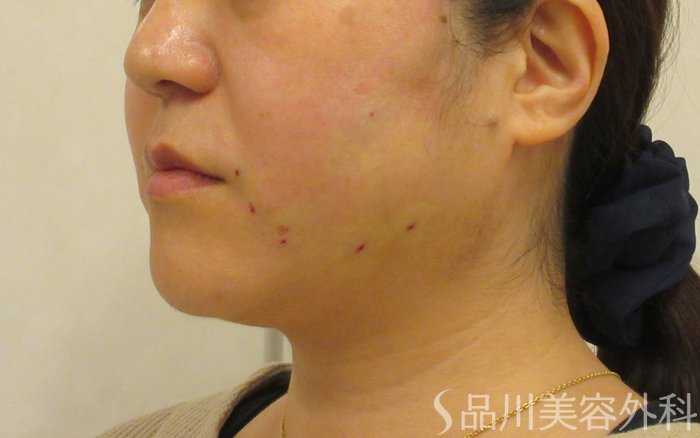 症例NO.73076のAFTER写真