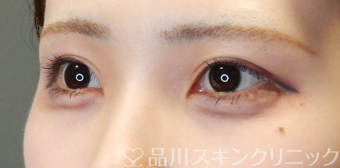 症例NO.65100のAFTER写真