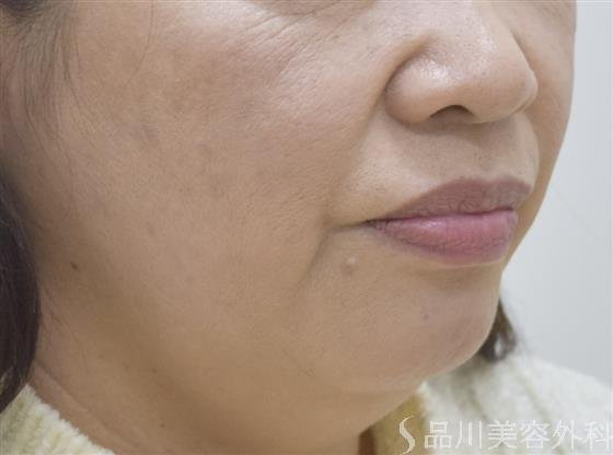 症例NO.47630のBEFORE写真