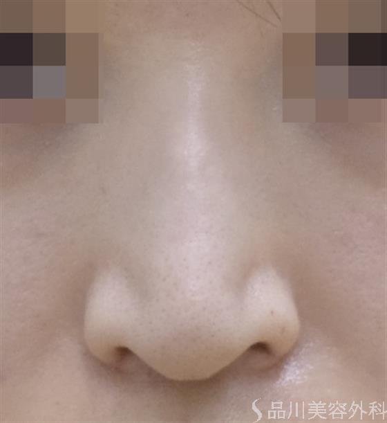 症例NO.50388のAFTER写真