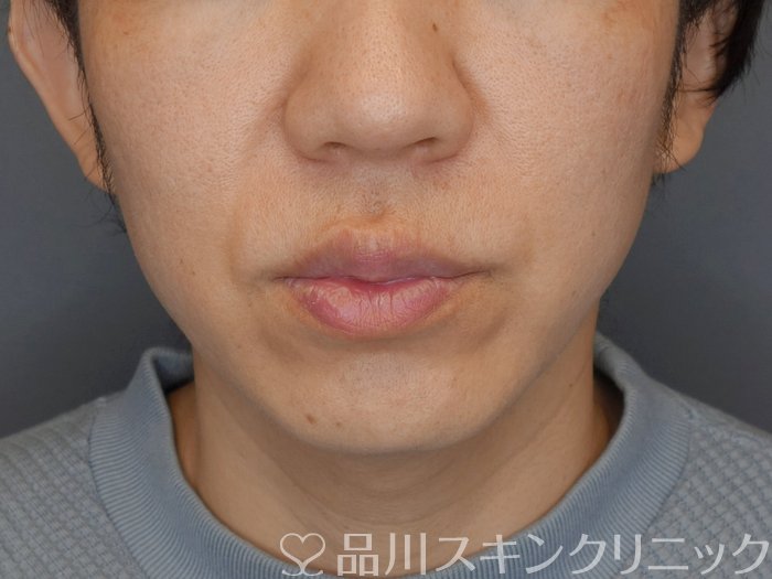 症例NO.71971のBEFORE写真