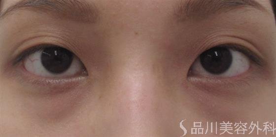 症例NO.23204のBEFORE写真