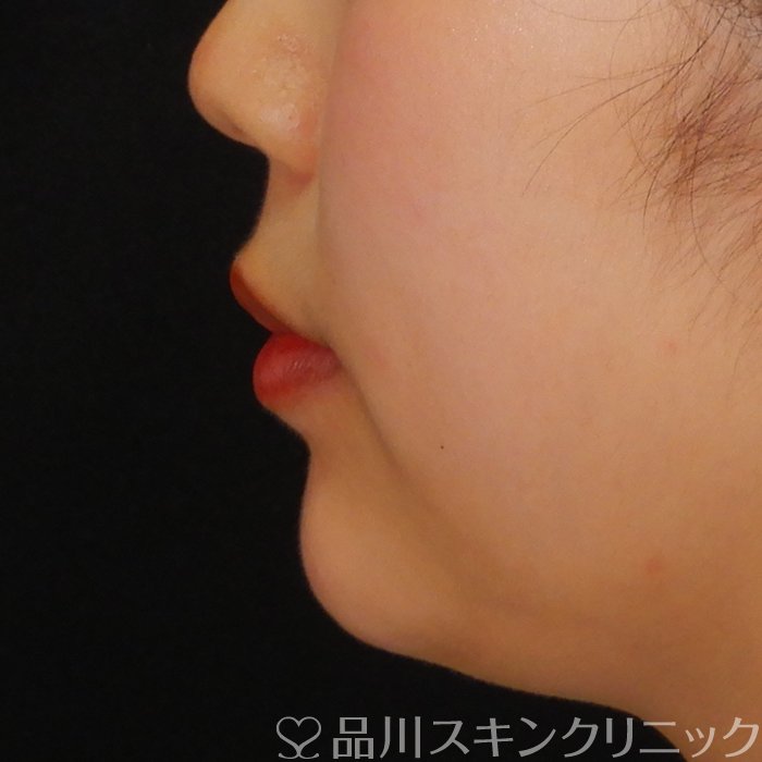 症例NO.69764のAFTER写真