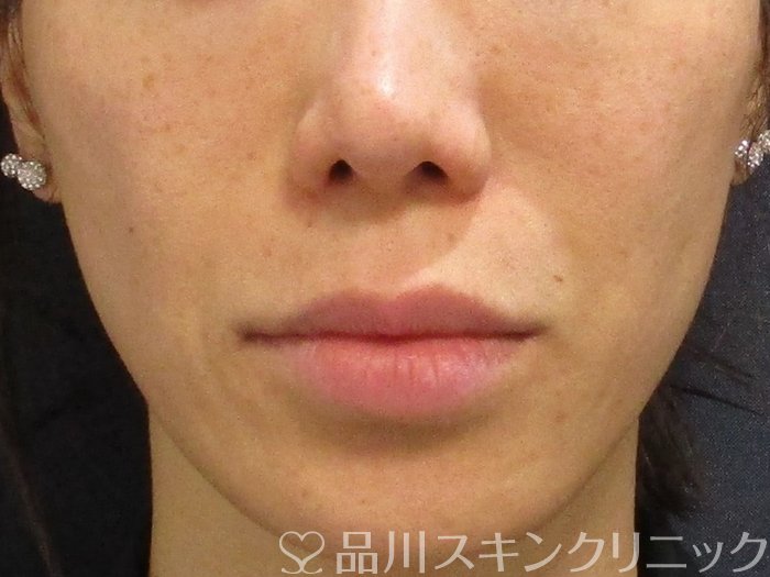 症例NO.74198のBEFORE写真