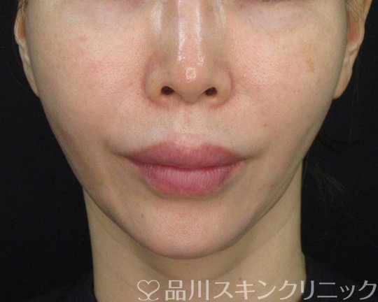 症例NO.74449のAFTER写真