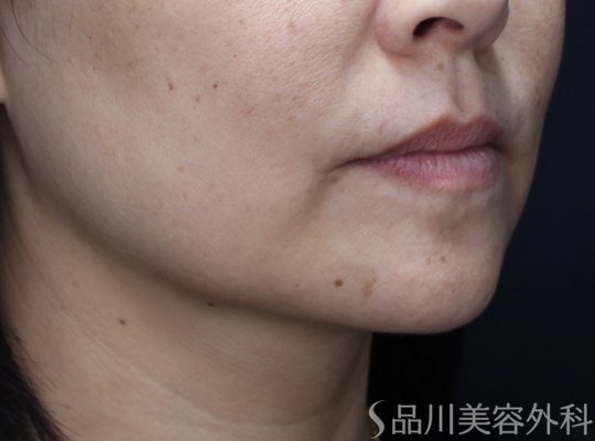 症例NO.71938のBEFORE写真
