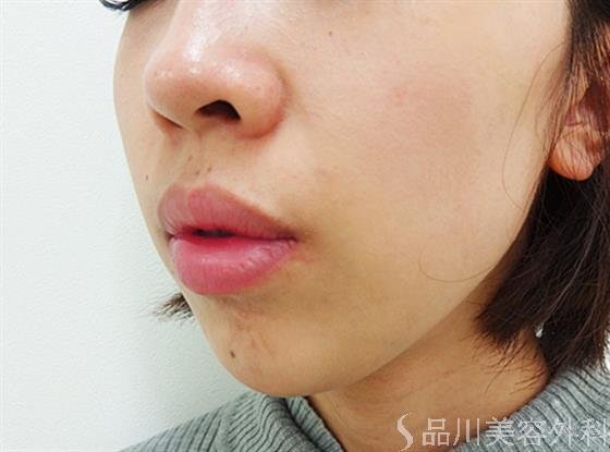 症例NO.21955のAFTER写真