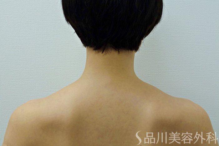 症例NO.71454のBEFORE写真