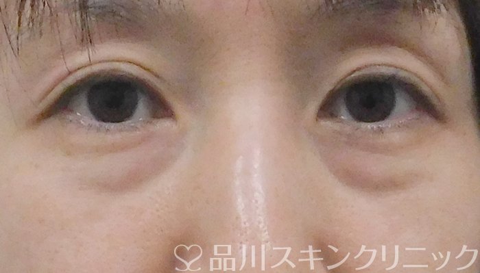 症例NO.63017のBEFORE写真