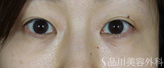 症例NO.69753のAFTER写真