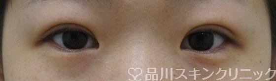症例NO.36962のAFTER写真