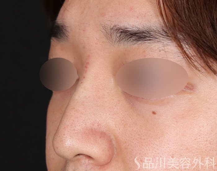 症例NO.71262のAFTER写真