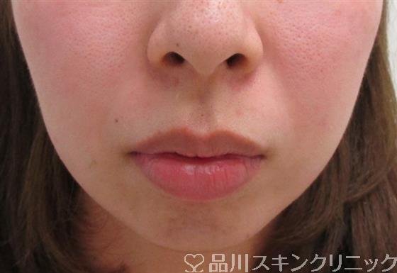 症例NO.34789のBEFORE写真