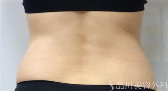 症例NO.43570のBEFORE写真