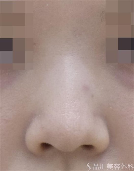 症例NO.57974のBEFORE写真
