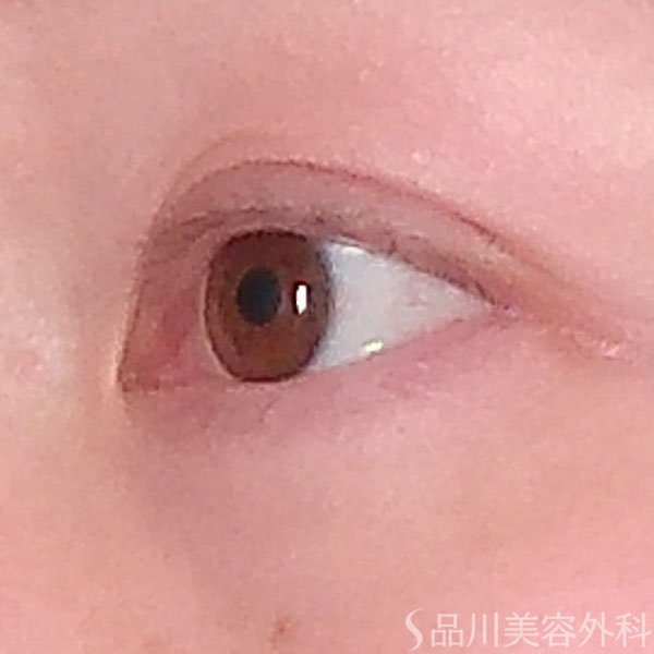 症例NO.69589のAFTER写真
