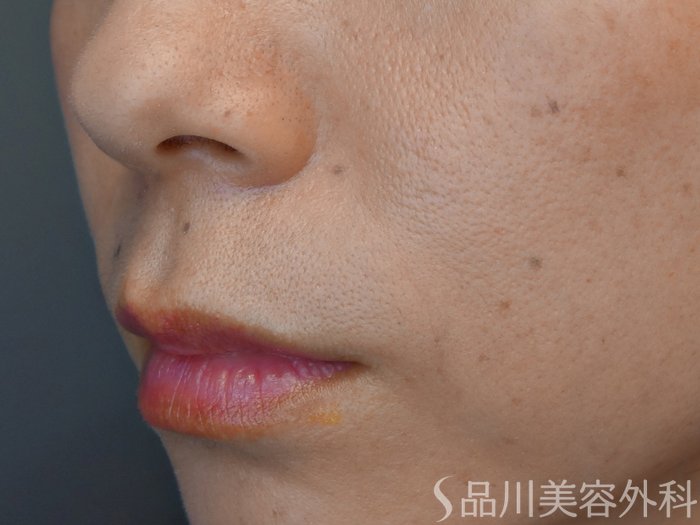 症例NO.71432のBEFORE写真