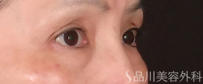 症例NO.70126のBEFORE写真
