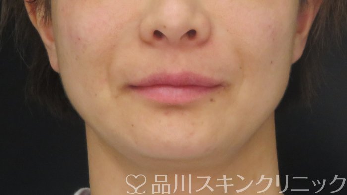 症例NO.72762のAFTER写真