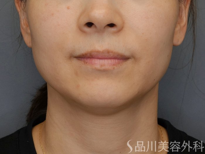 症例NO.72678のBEFORE写真