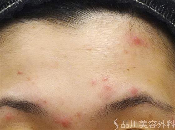症例NO.25257のBEFORE写真