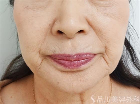 症例NO.33025のBEFORE写真