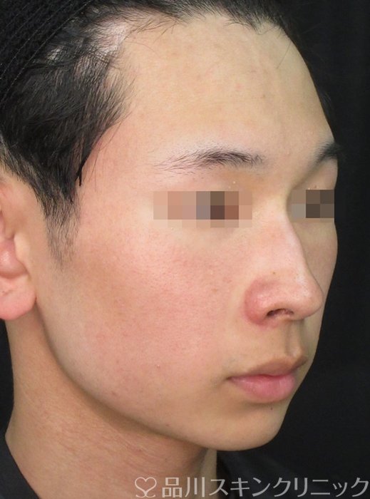 症例NO.73057のAFTER写真