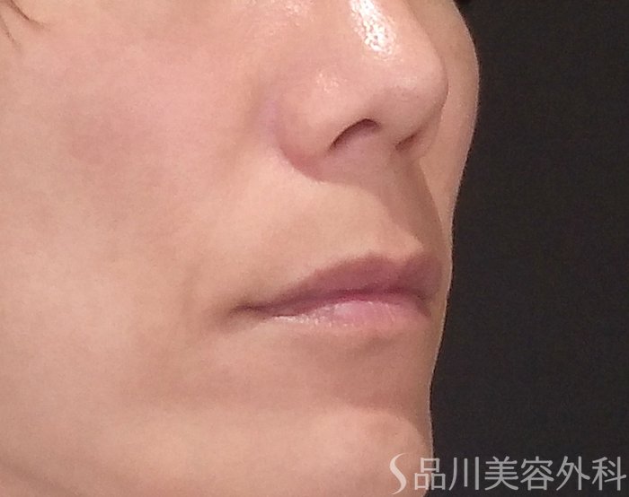 症例NO.70497のBEFORE写真