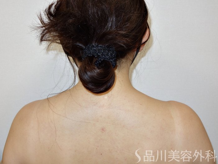 症例NO.73271のBEFORE写真