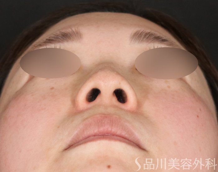 症例NO.72957のBEFORE写真