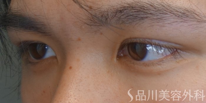 症例NO.69640のAFTER写真