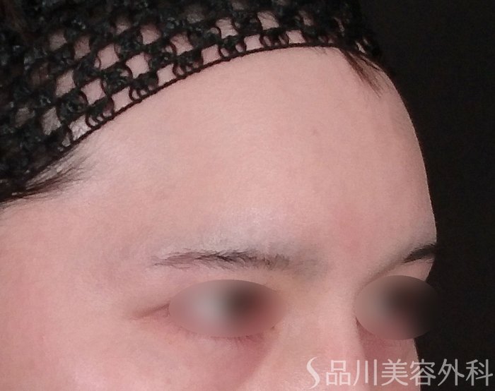 症例NO.69663のBEFORE写真