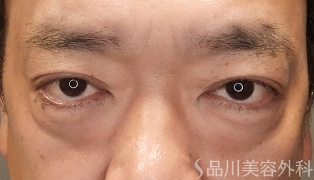 症例NO.75042のBEFORE写真