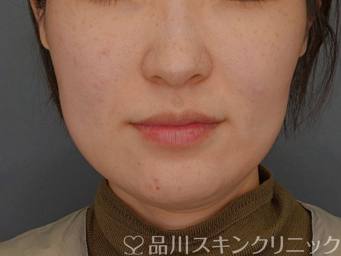 症例NO.74363のBEFORE写真