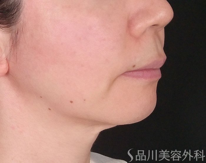 症例NO.70451のBEFORE写真