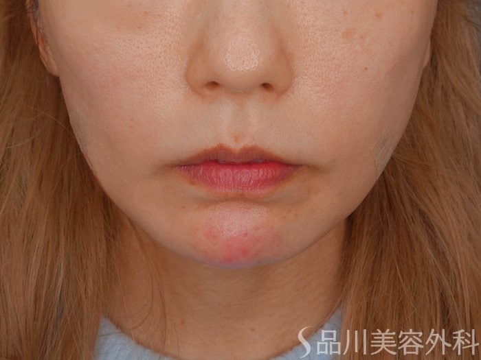 症例NO.72467のAFTER写真