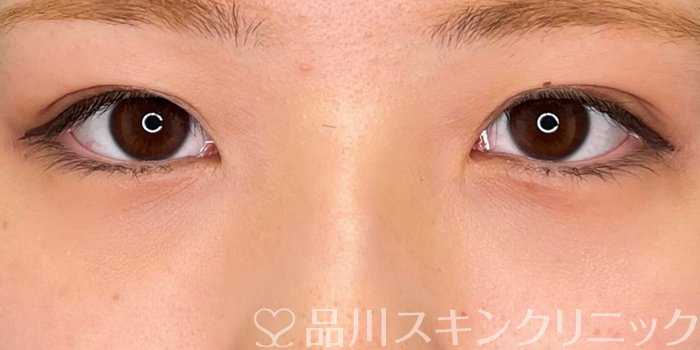 症例NO.69726のAFTER写真
